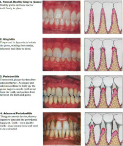 Periodontal Exam Explanation - All Heart Dental